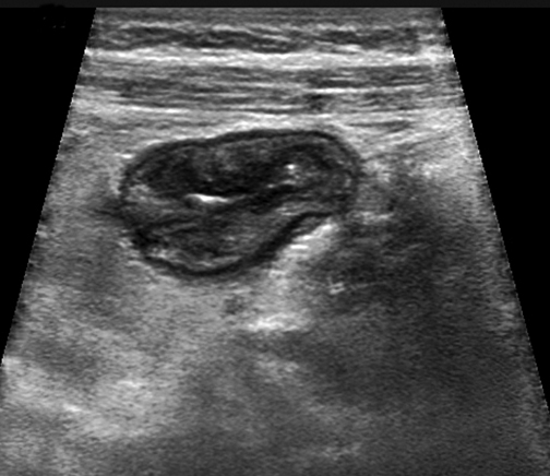 Longitudinal image of the terminal ileum show thickend bowel wall and