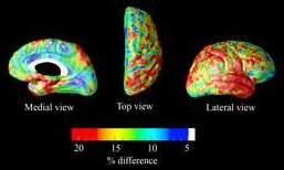 Percent difference in cortical atrophy between MCI and Alzheimer's disease