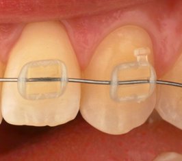 Dental brackets made of the new polymer material