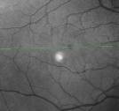 A Heidelberg Spectralis HRA+OCT image of a retina