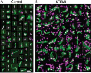 images showing normal normal circulating endothelial cells and those of heart attack patients